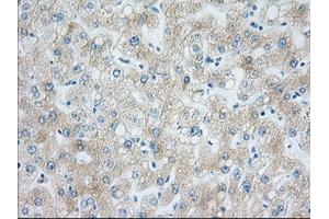 Immunohistochemical staining of paraffin-embedded Carcinoma of Human liver tissue using anti-H6PD mouse monoclonal antibody. (Glucose-6-Phosphate Dehydrogenase 抗体)