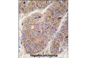 Formalin-fixed and paraffin-embedded human hepatocarcinoma tissue reacted with APOA2 antibody , which was peroxidase-conjugated to the secondary antibody, followed by DAB staining. (APOA2 抗体  (AA 28-56))