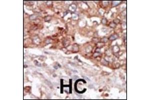 Formalin-fixed and paraffin-embedded human cancer tissue reacted with the primary antibody, which was peroxidase-conjugated to the secondary antibody, followed by AEC staining. (BLK 抗体  (N-Term))