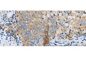 Immunohistochemistry of paraffin-embedded Human cervical cancer tissue using CLTB Polyclonal Antibody at dilution of 1:70(x200) (CLTB 抗体)