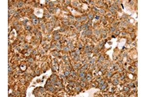 The image on the left is immunohistochemistry of paraffin-embedded Human breast cancer tissue using ABIN7192683(STK32B Antibody) at dilution 1/25, on the right is treated with synthetic peptide. (STK32B 抗体)