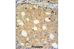 CK2 Antibody (Center) (ABIN651399 and ABIN2840216) IHC analysis in formalin fixed and paraffin embedded human prostate carcinoma followed by peroxidase conjugation of the secondary antibody and DAB staining. (CMPK2 抗体  (AA 142-170))