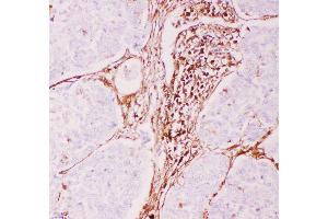 Anti-P Glycoprotein Picoband antibody,  IHC(P): Human Lung Cancer Tissue