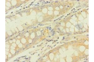 Immunohistochemistry of paraffin-embedded human colon cancer using ABIN7166896 at dilution of 1:100 (PDHA1 抗体  (AA 223-390))