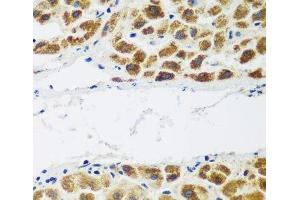 Immunohistochemistry of paraffin-embedded Human liver cancer using NAA60 Polyclonal Antibody at dilution of 1:200 (40x lens). (NAT15 抗体)