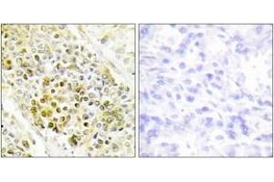 Immunohistochemistry analysis of paraffin-embedded human lung carcinoma tissue, using DLX5 Antibody. (DLX5 抗体  (AA 91-140))