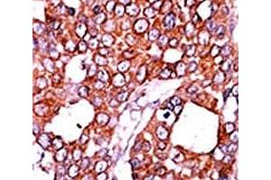 IHC analysis of FFPE human breast carcinoma tissue stained with the CDC25A antibody. (CDC25A 抗体  (pThr507))