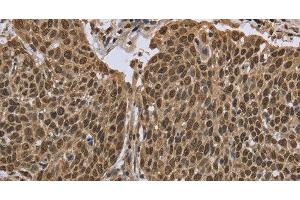 Immunohistochemistry of paraffin-embedded Human cervical cancer using PPAT Polyclonal Antibody at dilution of 1:50 (PPAT 抗体)