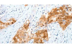 Immunohistochemistry of paraffin-embedded Human cervical cancer using ANXA8 Polyclonal Antibody at dilution of 1:35 (Annexin VIII 抗体)