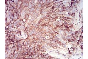 Immunohistochemical analysis of paraffin-embedded bladder cancer tissues using SERPINA1 mouse mAb with DAB staining. (SERPINA1 抗体  (AA 23-237))