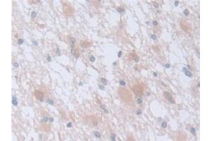 Detection of CAPNS1 in Human Glioma Tissue using Polyclonal Antibody to Calpain, Small Subunit 1 (CAPNS1) (Calpain S1 抗体  (AA 1-268))