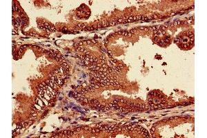 Immunohistochemistry of paraffin-embedded human prostate cancer using ABIN7164964 at dilution of 1:100 (PSMA7 抗体  (AA 5-232))