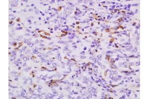 Formalin-fixed and paraffin embedded human cholangiocarcinoma tissue labeled with Anti-S100-A9 Polyclonal Antibody, Unconjugated  followed by conjugation to the secondary antibody and DAB staining. (S100A9 抗体  (AA 51-114))