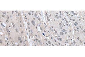 Immunohistochemistry of paraffin-embedded Human esophagus cancer tissue using PRAME Polyclonal Antibody at dilution of 1:65(x200) (PRAME 抗体)