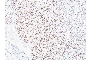 Formalin-fixed, paraffin-embedded human melanoma stained with MITF antibody (D5).