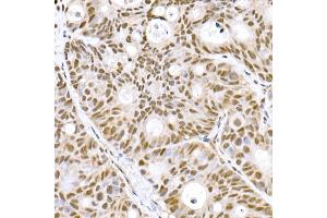 Immunohistochemistry of paraffin-embedded human colon carcinoma using Prdm9 Rabbit mAb (ABIN7269500) at dilution of 1:800 (40x lens). (PRDM9 抗体)