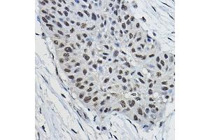 Immunohistochemistry of paraffin-embedded human lung cancer using BRAP Rabbit pAb (ABIN7265922) at dilution of 1:100 (40x lens). (BRAP 抗体  (AA 1-200))