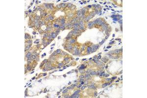 Immunohistochemistry of paraffin-embedded human gastric cancer using PFKM antibody at dilution of 1:100 (x40 lens). (PFKM 抗体)