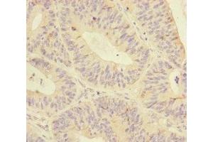 Immunohistochemistry of paraffin-embedded human colon cancer using ABIN7145574 at dilution of 1:100 (MTHFD2 抗体  (AA 40-250))