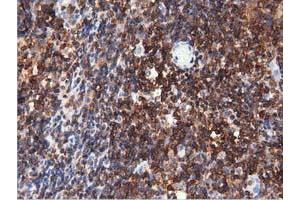 Immunohistochemical staining of paraffin-embedded Human lymphoma tissue using anti-ARHGAP25 mouse monoclonal antibody. (ARHGAP25 抗体)