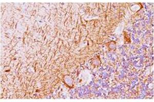 Immunohistochemical staining of human Ewing’s sarcoma with NKX2-2 monoclonal antibody, clone SPM564 . (Nkx2-2 抗体)