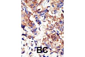 Formalin-fixed and paraffin-embedded human cancer tissue reacted with UBQLN2 polyclonal antibody  , which was peroxidase-conjugated to the secondary antibody, followed by DAB staining. (Ubiquilin 2 抗体  (N-Term))