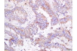 Formalin-fixed and paraffin embedded human lung carcinoma labeled with Rabbit Anti-ODC Polyclonal Antibody, Unconjugated (ABIN674559) at 1:200 followed by conjugation to the secondary antibody and DAB staining (ODC1 抗体  (AA 321-461))