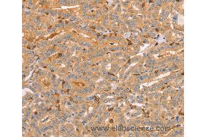 Immunohistochemistry of Human liver cancer using CCL16  Polyclonal Antibody at dilution of 1:60 (CCL16 抗体)