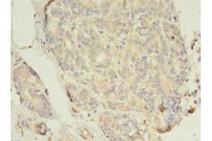 Immunohistochemistry of paraffin-embedded human breast cancer using ABIN7152043 at dilution of 1:100 (Estrogen Receptor alpha 抗体  (AA 10-591))