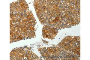 Immunohistochemistry of Human liver cancer using PTPN6 Polyclonal Antibody at dilution of 1:35 (SHP1 抗体)