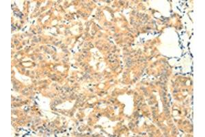 The image on the left is immunohistochemistry of paraffin-embedded Human thyroid cancer tissue using ABIN7131115(SNAP25 Antibody) at dilution 1/25, on the right is treated with fusion protein. (SNAP25 抗体)