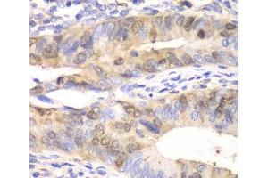 Immunohistochemistry of paraffin-embedded Human colon carcinoma using UBE2C Polyclonal Antibody at dilution of 1:100 (40x lens). (UBE2C 抗体)