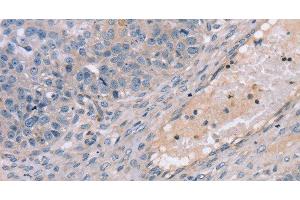 Immunohistochemistry of paraffin-embedded Human breast cancer using TERT Polyclonal Antibody at dilution of 1:35 (TERT 抗体)