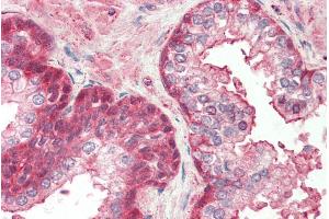 Immunohistochemistry (IHC) image for anti-Regulator of Chromosome Condensation (RCC1) and BTB (POZ) Domain Containing Protein 2 (RCBTB2) (Internal Region) antibody (ABIN570703)