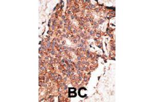 Formalin-fixed and paraffin-embedded human cancer tissue reacted with BMP1 polyclonal antibody  , which was peroxidase-conjugated to the secondary antibody, followed by AEC staining. (BMP1 抗体  (C-Term))