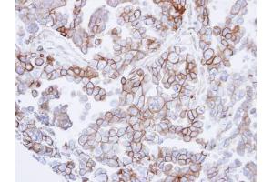 IHC-P Image Immunohistochemical analysis of paraffin-embedded OVCAR3 xenograft , using SNTB2, antibody at 1:500 dilution. (SNTB2 抗体)