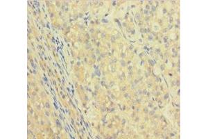 Immunohistochemistry of paraffin-embedded human liver cancer using ABIN7156085 at dilution of 1:100 (IGHG1 抗体  (AA 1-330))