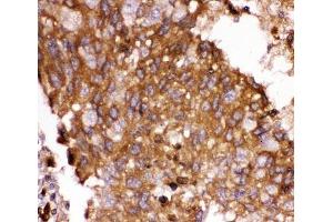 IHC-P: FOXO3A antibody testing of human lung cancer tissue (FOXO3 抗体  (AA 471-673))