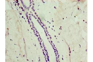 Immunohistochemistry of paraffin-embedded human breast cancer using ABIN7149025 at dilution of 1:100 (ATG4C 抗体  (AA 259-458))