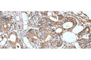 Immunohistochemistry of paraffin-embedded Human colorectal cancer tissue using APOD Polyclonal Antibody at dilution of 1:55(x200) (Apolipoprotein D 抗体)