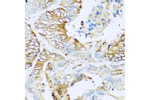 Immunohistochemistry of paraffin-embedded human colon carcinoma using APOC1 antibody at dilution of 1:100 (40x lens). (APOC1 抗体)