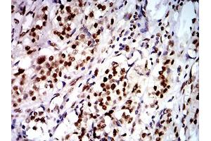 Immunohistochemical analysis of paraffin-embedded bladder cancer tissues using DDX1 mouse mAb with DAB staining. (DDX1 抗体  (AA 642-740))