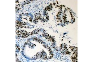 Immunohistochemical analysis of Lamin A/C (pS392) staining in human colon cancer formalin fixed paraffin embedded tissue section. (Lamin A/C 抗体  (pSer392))