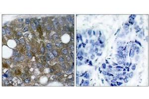 Immunohistochemical analysis of paraffin- embedded human breast carcinoma tissue using HSP27 (phospho-Ser15) antibody (E011164). (HSP27 抗体  (pSer15))