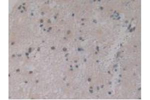 IHC-P analysis of Human Glioma Tissue, with DAB staining. (IGFBPI 抗体  (AA 36-235))