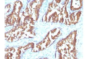 Formalin-fixed, paraffin-embedded human Prostate Carcinoma stained with IDH1 Mouse Monoclonal Antibody (IDH1/1152). (IDH1 抗体  (AA 281-414))