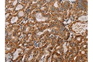 The image on the left is immunohistochemistry of paraffin-embedded Human thyroid cancer tissue using ABIN7130292(MTFR1 Antibody) at dilution 1/40, on the right is treated with fusion protein. (MTFR1 抗体)