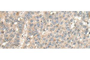 Immunohistochemistry of paraffin-embedded Human liver cancer tissue using CASQ1 Polyclonal Antibody at dilution of 1:100(x200) (Calsequestrin 抗体)