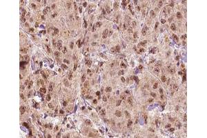 ABIN6266879 at 1/100 staining human Breast carcinoma tissue sections by IHC-P. (MAGEA1 抗体  (C-Term))