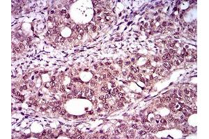 Immunohistochemical analysis of paraffin-embedded cervical cancer tissues using T mouse mAb with DAB staining. (T Antigen (AA 257-309) 抗体)